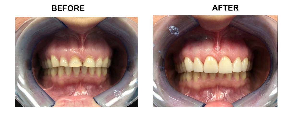 Veneers